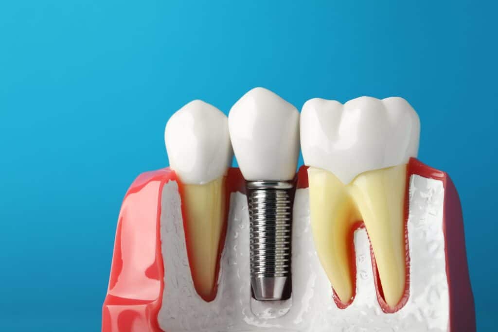 Side view cut-out of dental implant showing how it attaches into the gums - on blue background.