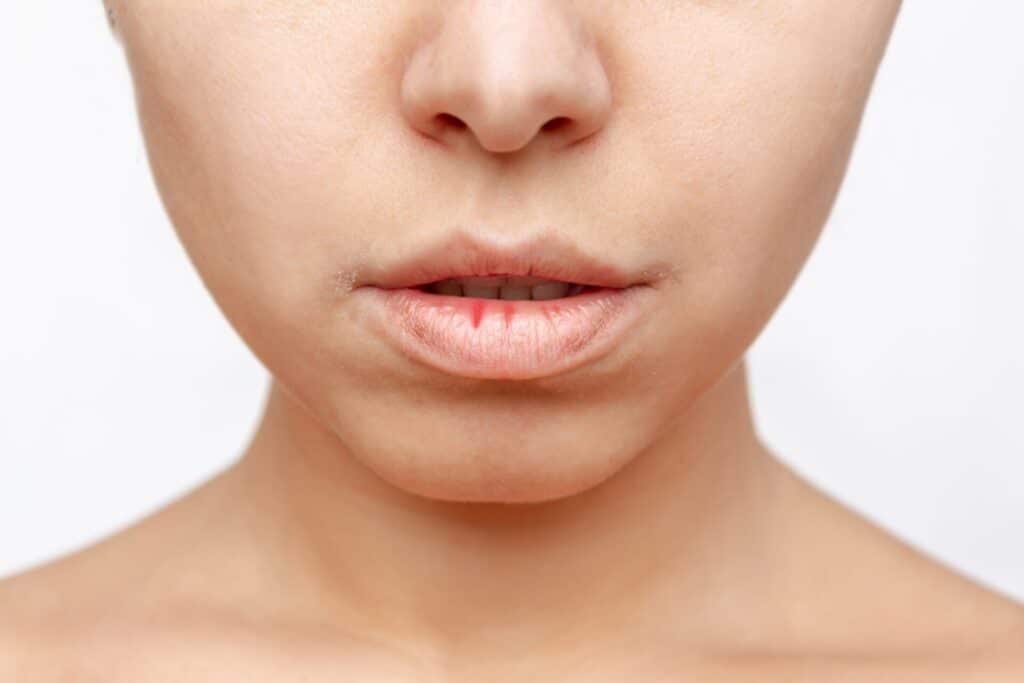 Close up image of a woman's face with dry lips.