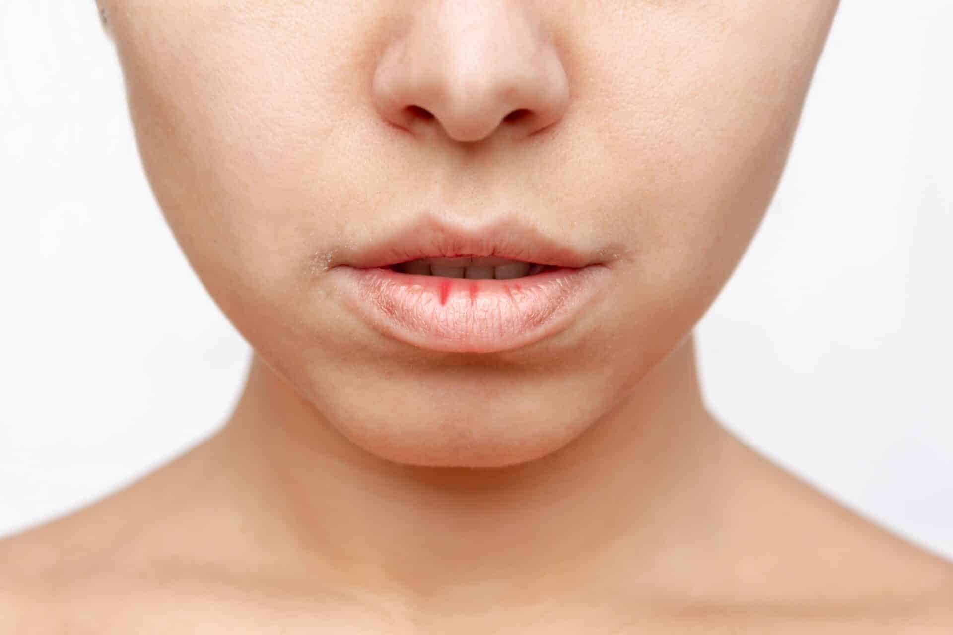 Close up image of a woman's face with dry lips.