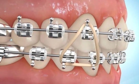 Animated image of Triangle Elastics placement for orthodontic rubber bands.